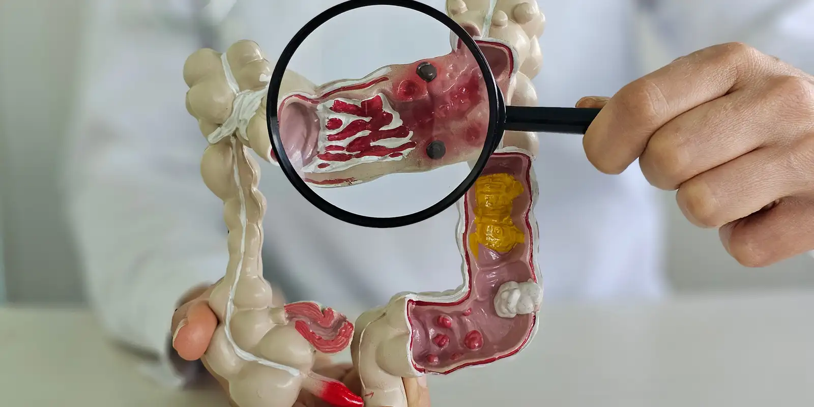 Doença Inflamatória Intestinal Cresce 5 Vezes no Brasil